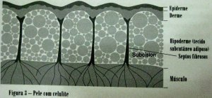 Tratamento cirúrgico da celulite 