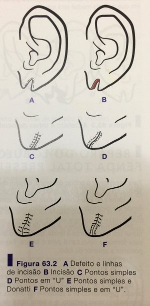 Correção lóbulo de orelha 